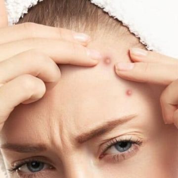 'Bản đồ' mụn trên khuôn mặt làm rõ nguyên nhân gây mụn