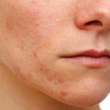 Cách trị mụn cám từ thiên nhiên bạn phải nhớ