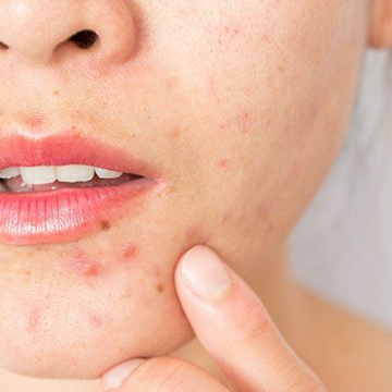 Cách loại bỏ những vết mụn khó chịu trên khuôn mặt bạn
