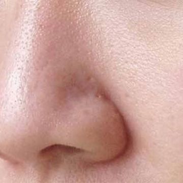 3 cách sẽ khít lỗ chân lông vô cùng hiệu quả